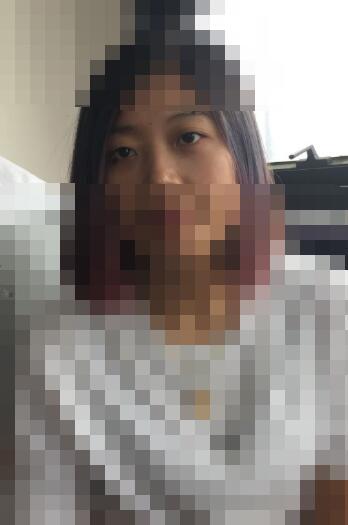 李女士更换义眼片后效果图