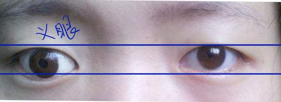 义眼是否能看见介绍 义眼是否能看见介绍