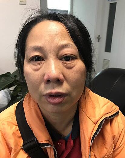 义眼安装案例 义眼安装案例