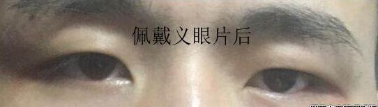 佩戴义眼片之后 佩戴义眼片之后