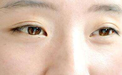 仿真义眼片的制作应用及护理 仿真义眼片的制作应用及护理