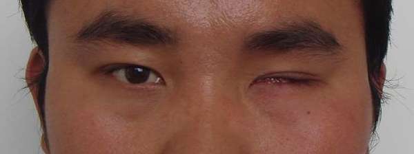 佩戴义眼前客照 佩戴义眼前客照