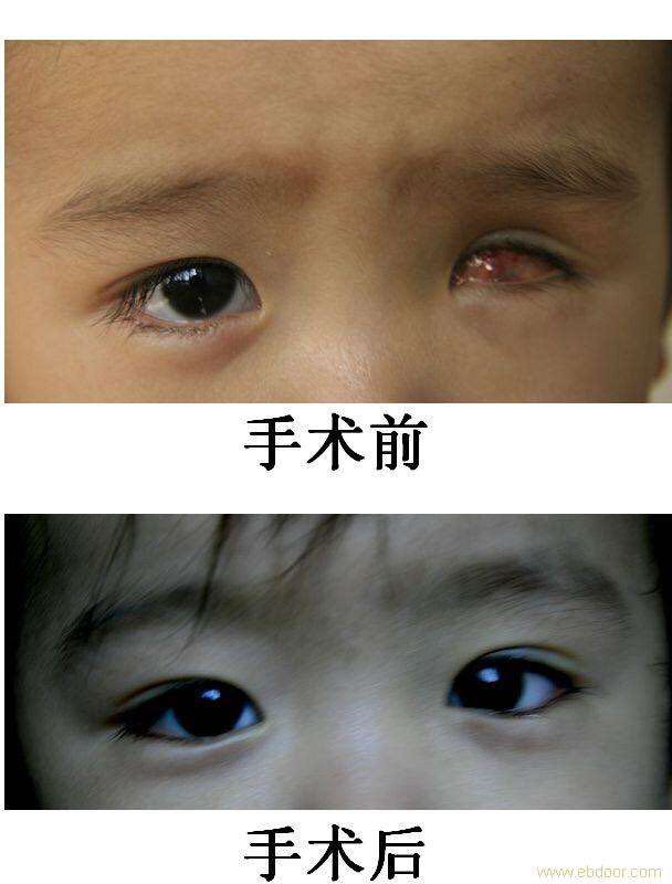 儿童配搭义眼效果图