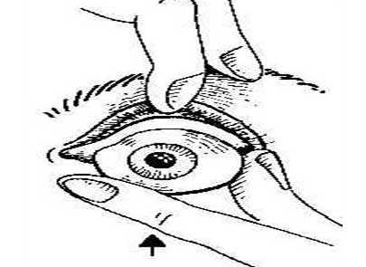 义眼片紧紧卡在眼结膜囊里时是不会转动的