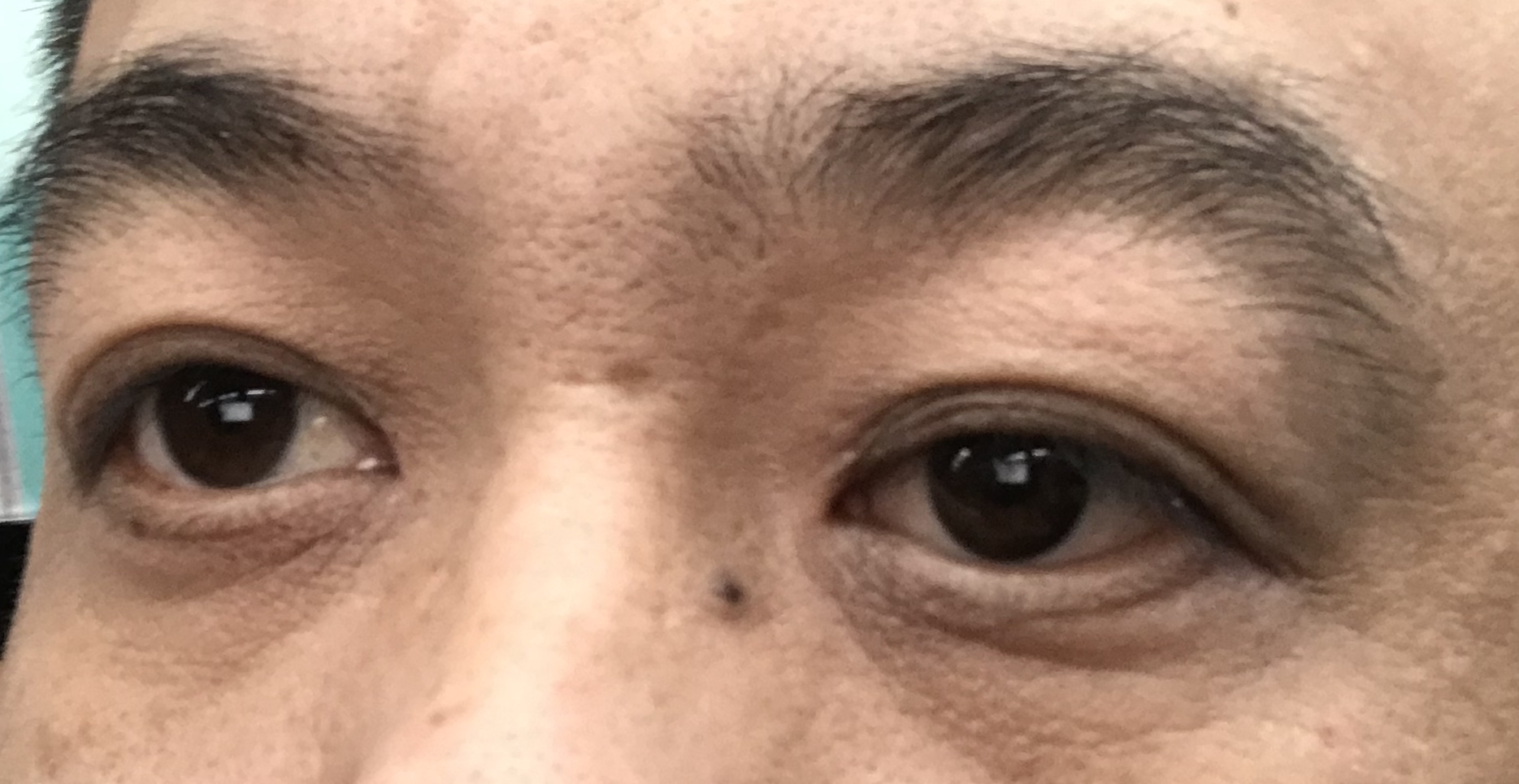 义眼定制的客户 义眼定制的客户