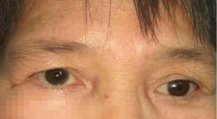 义眼佩戴的效果