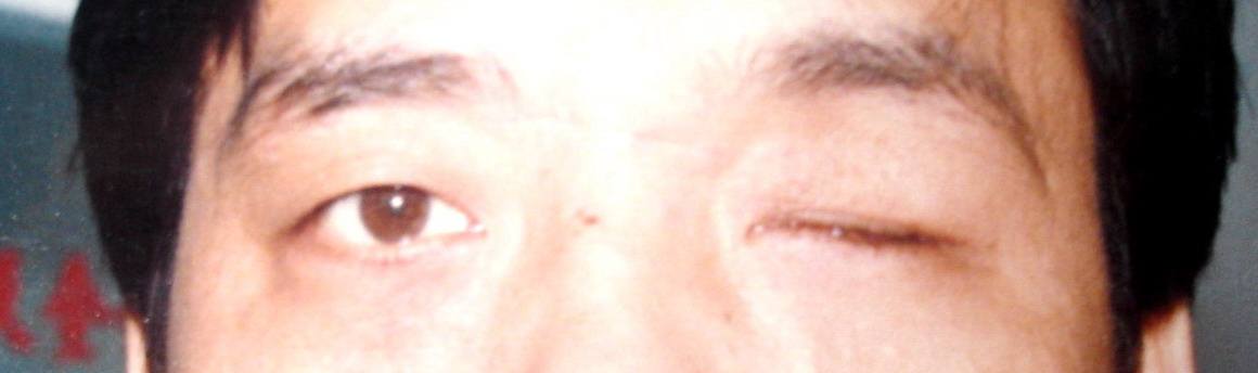 单眼失明客户 单眼失明客户