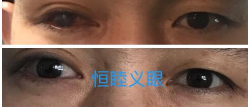 佩戴义眼的客户 佩戴义眼的客户