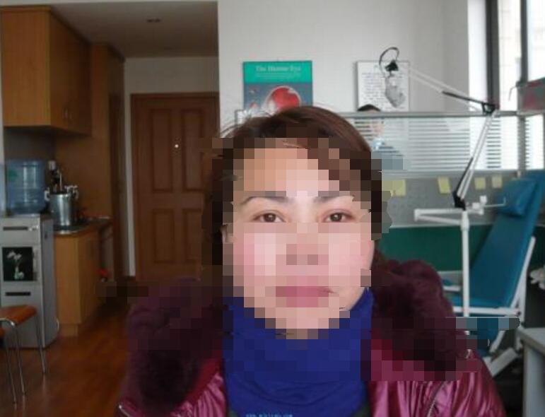 隐形义眼改善外观 隐形义眼改善外观